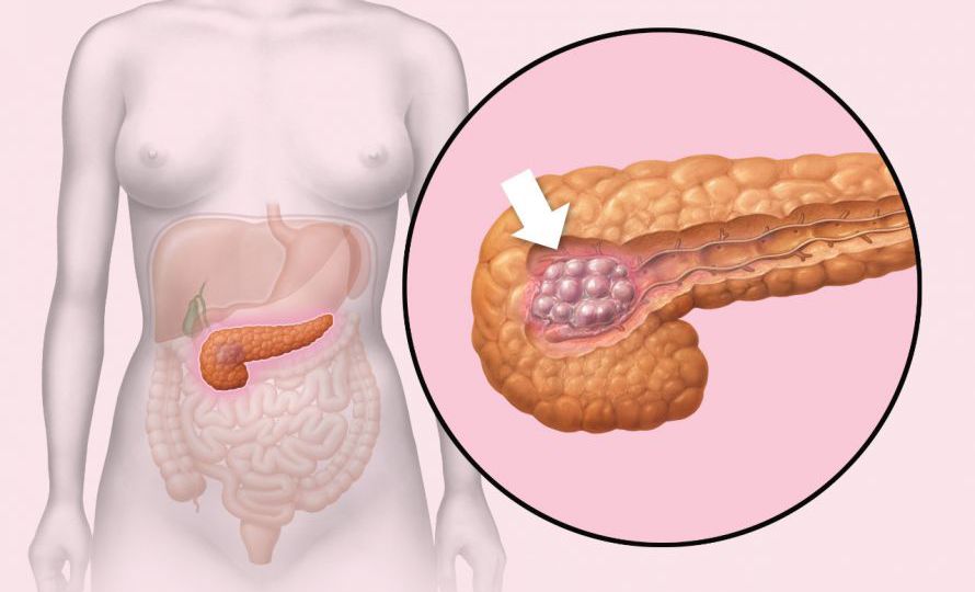 Chronic Pancreatitishead3