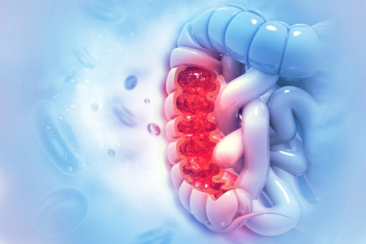 Colorectal-Cancer-_head_