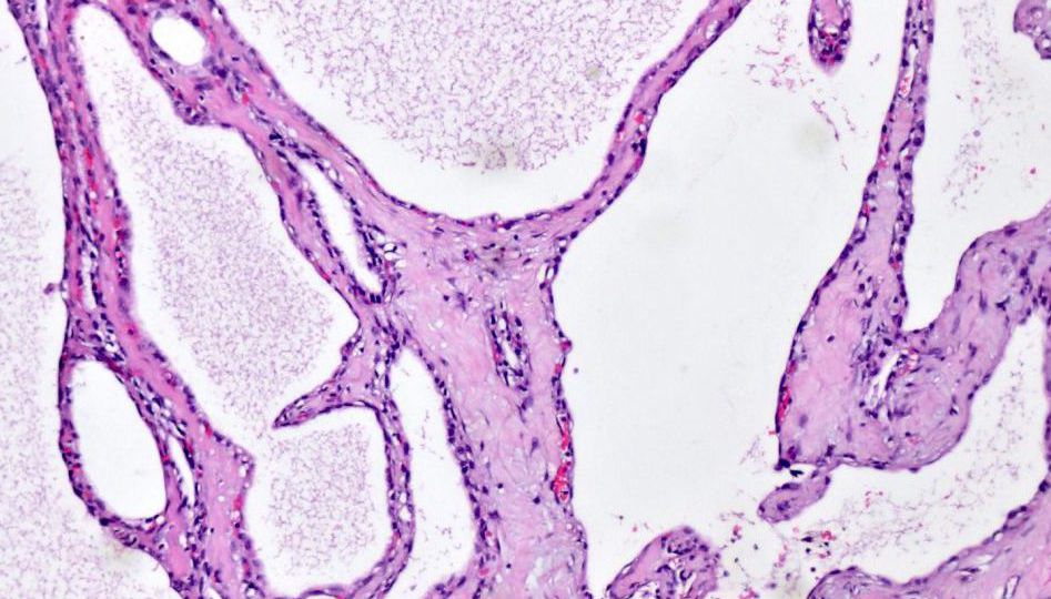 Cystadenocarcinoma pancreas