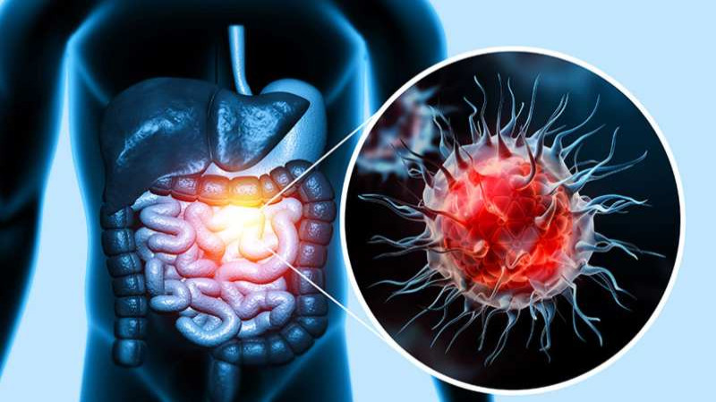 colorectal cancer head 1