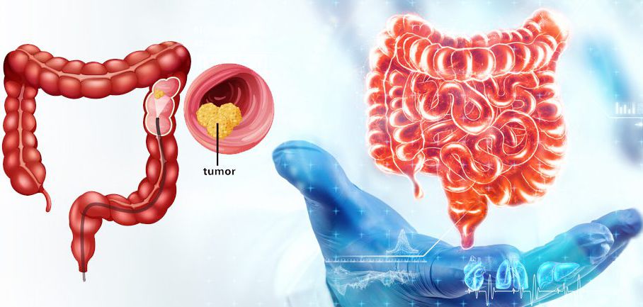 colorectal cancer head 13