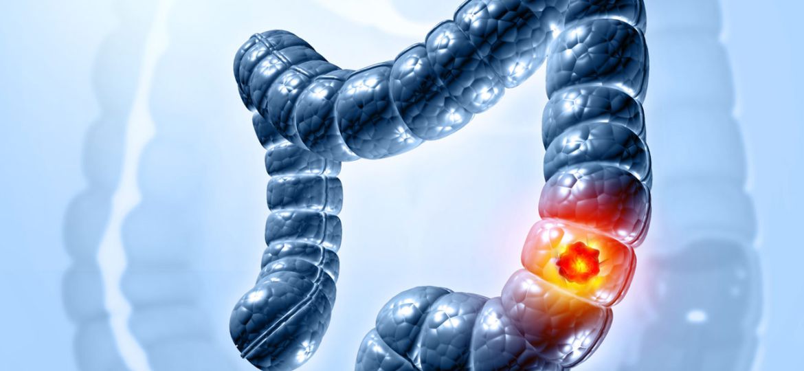 colorectal cancer head 14