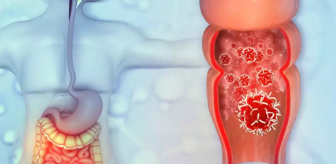 colorectal cancer head 2