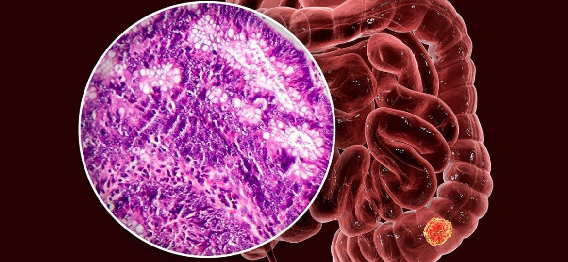colorectal cancer head 20
