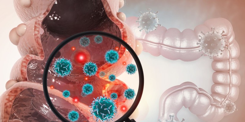 colorectal cancer head 4