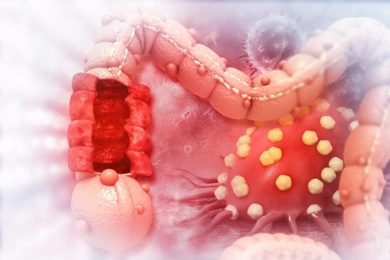 colorectal cancer head 5