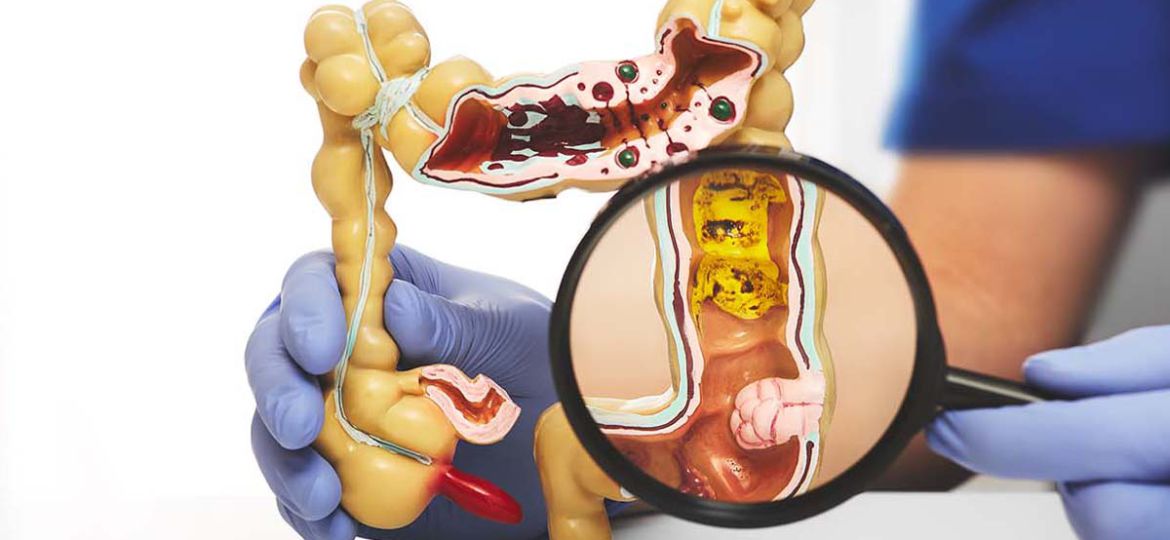 colorectal cancer head 7