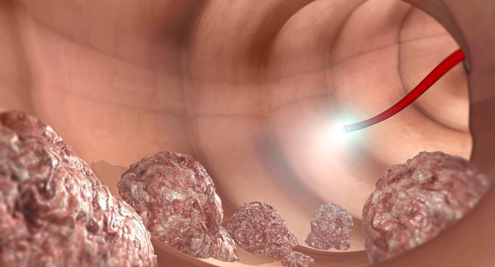 colorectal cancer head 9