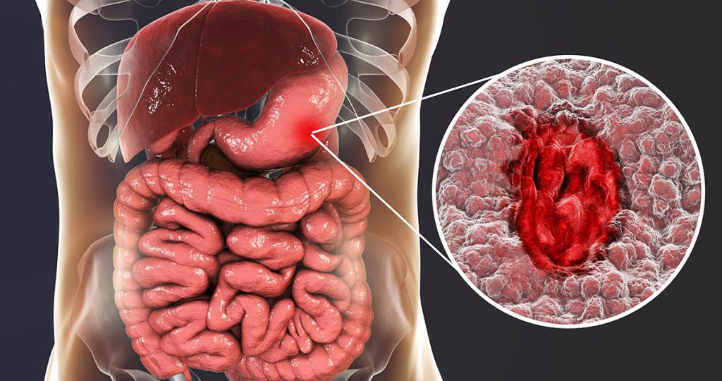 gastric ulcer head