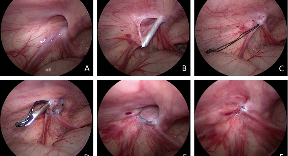 inguinal hernia head1