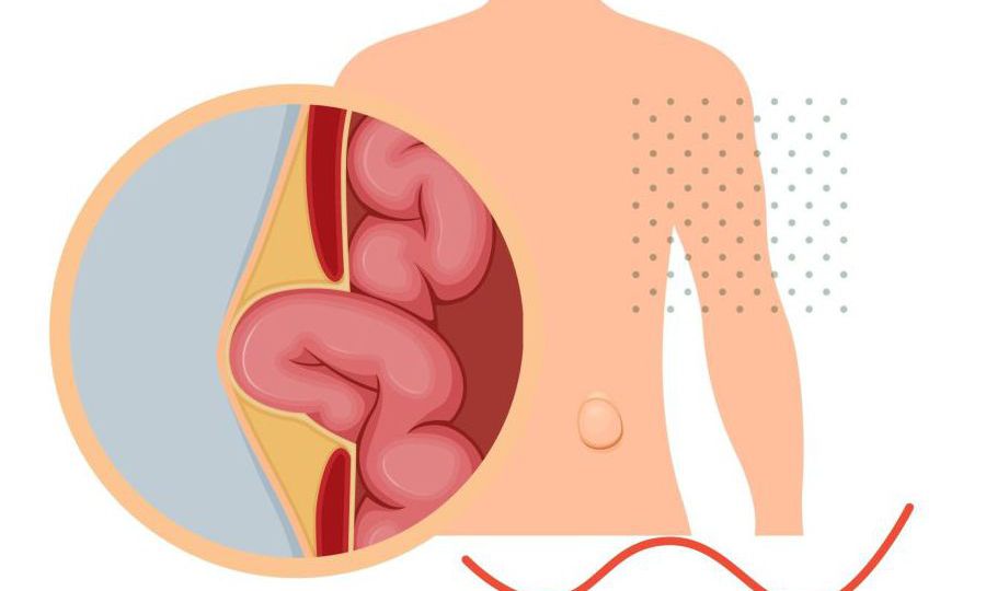 inguinal hernia head4