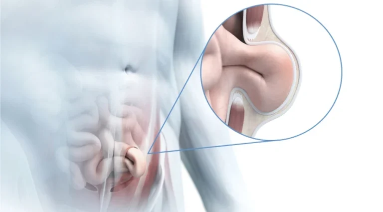 inguinal hernia head5