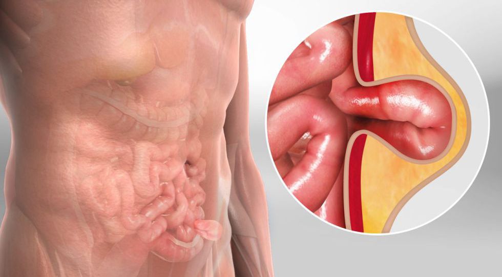 inguinal hernia head6