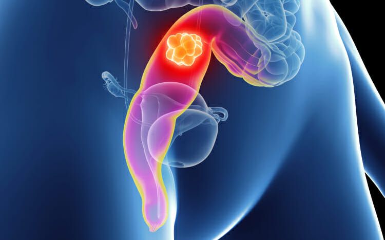 rectum baş1