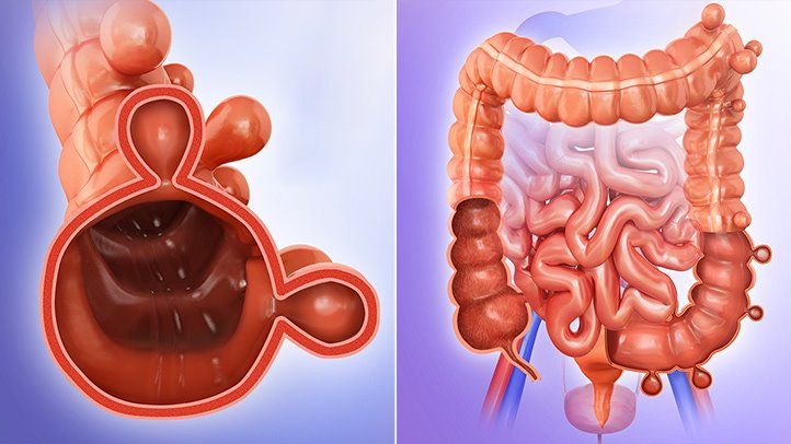 sigma Diverticulitis head