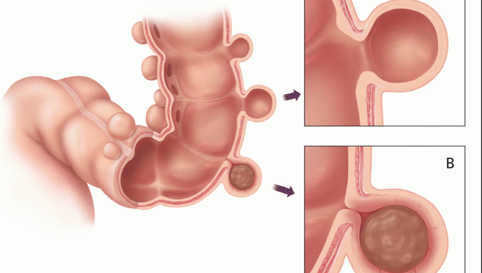 sigma Diverticulitis head2