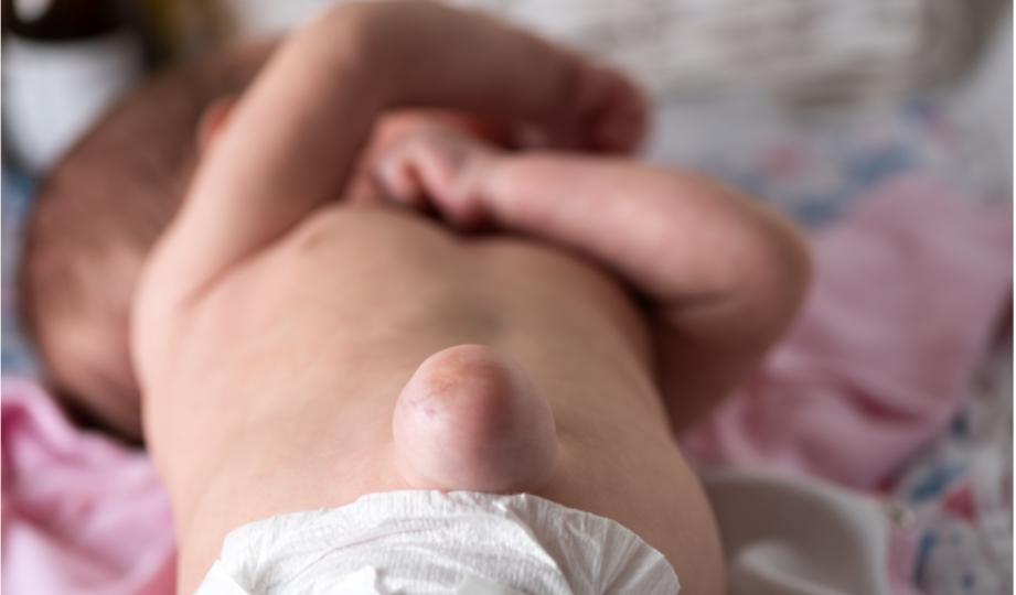 umbilical hernia head 2