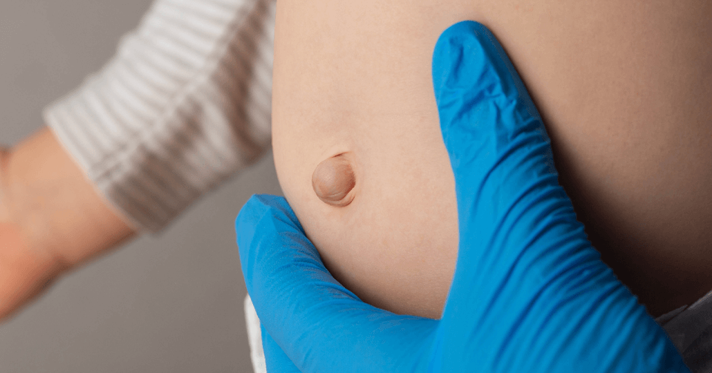 umbilical hernia head 3