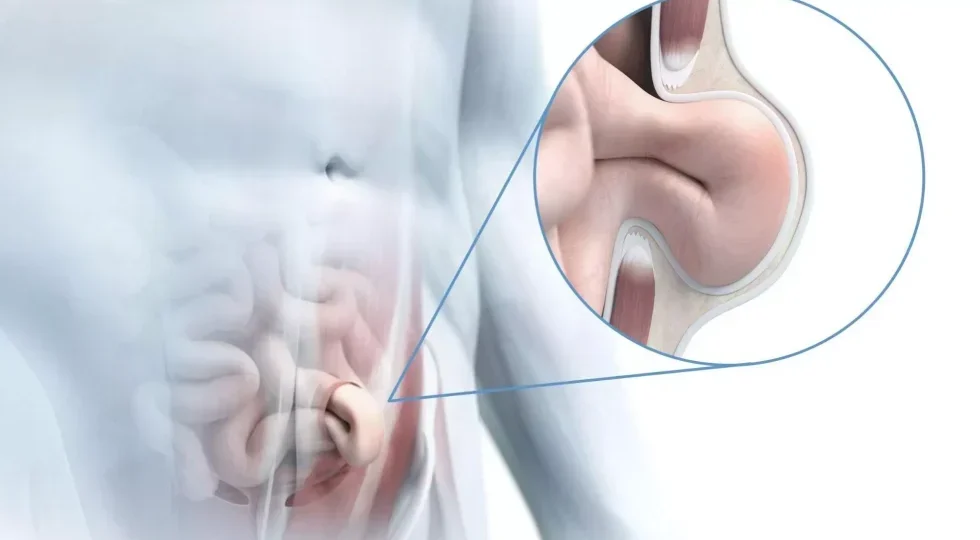 umbilical hernia head