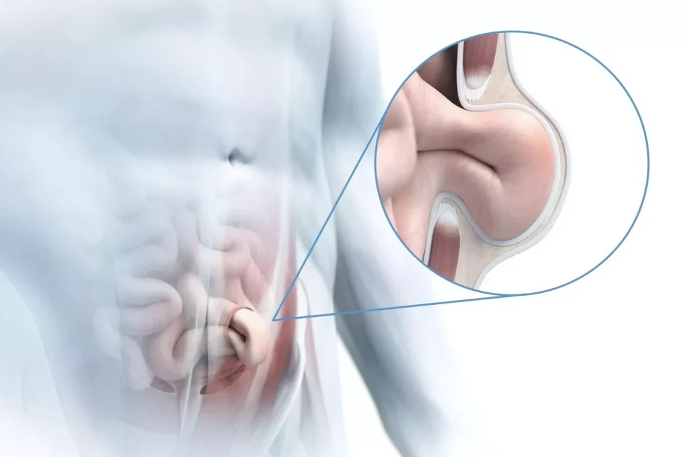 What should individuals with an umbilical hernia pay attention to while ...