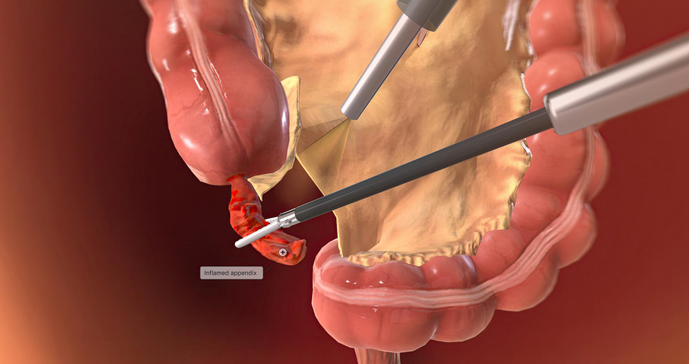 Appendectomy head5