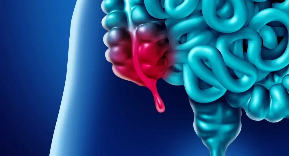 Appendectomy head9