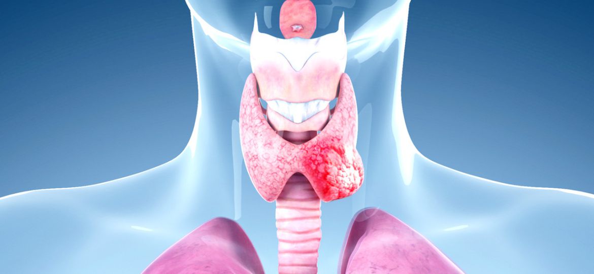 Benign Thyroid Tumors head2