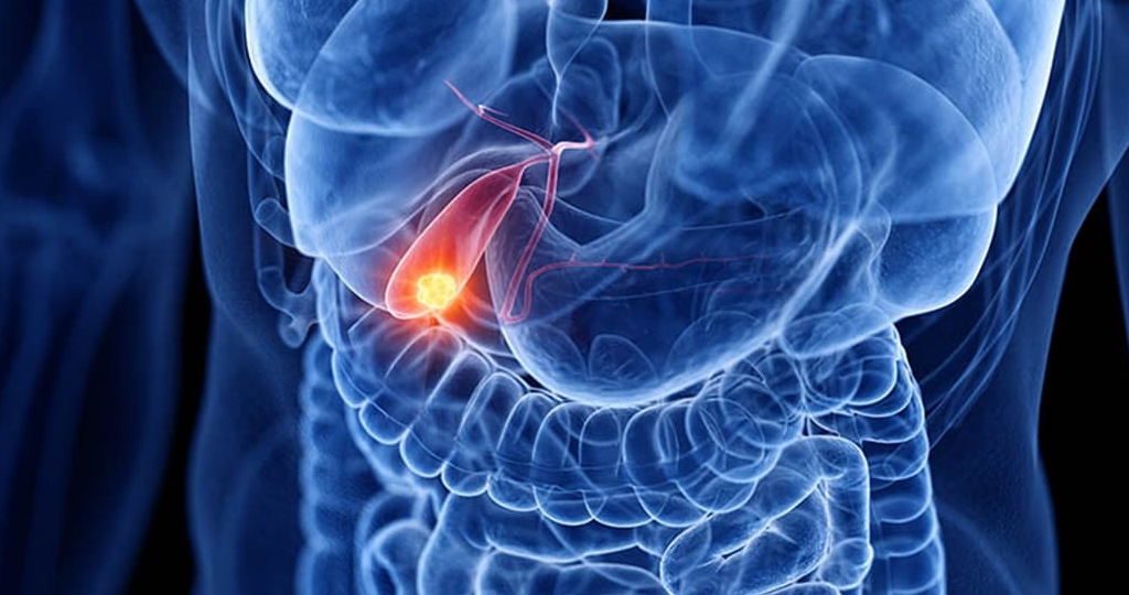 Bile Duct Cancer head1