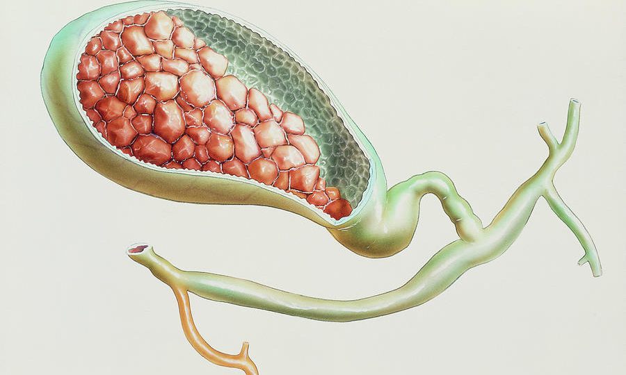 Bile Duct Stenosis HEAD1