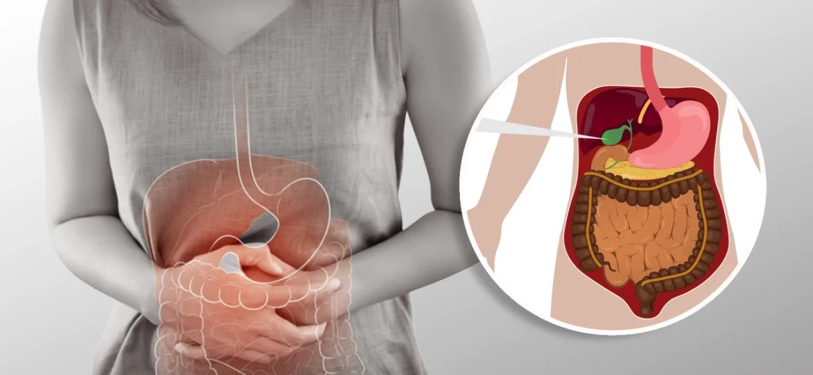Bile Duct Stenosis HEAD3