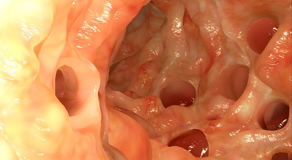 Diverticulitis head1