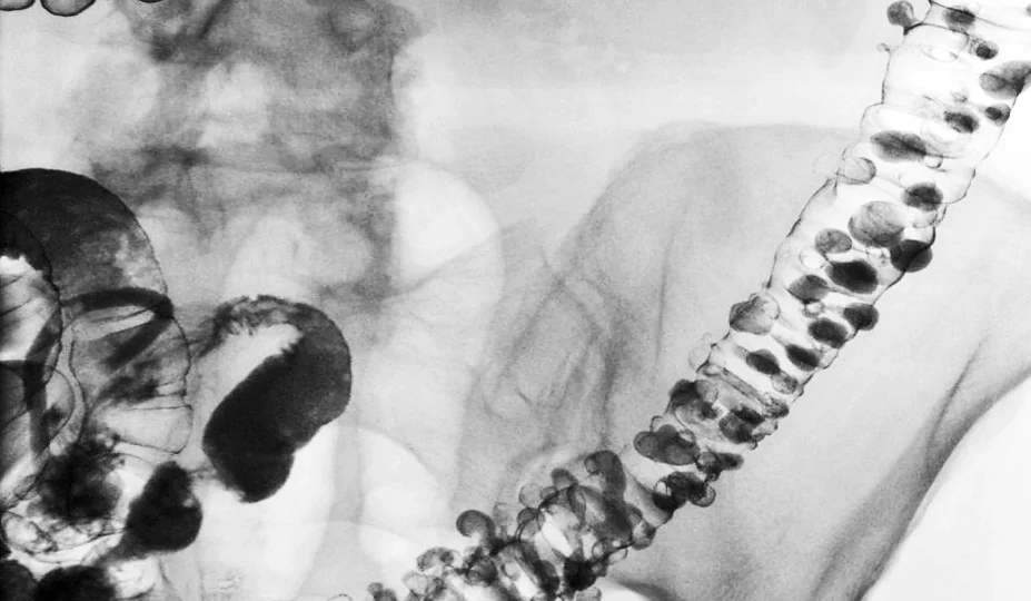 Diverticulitis head3
