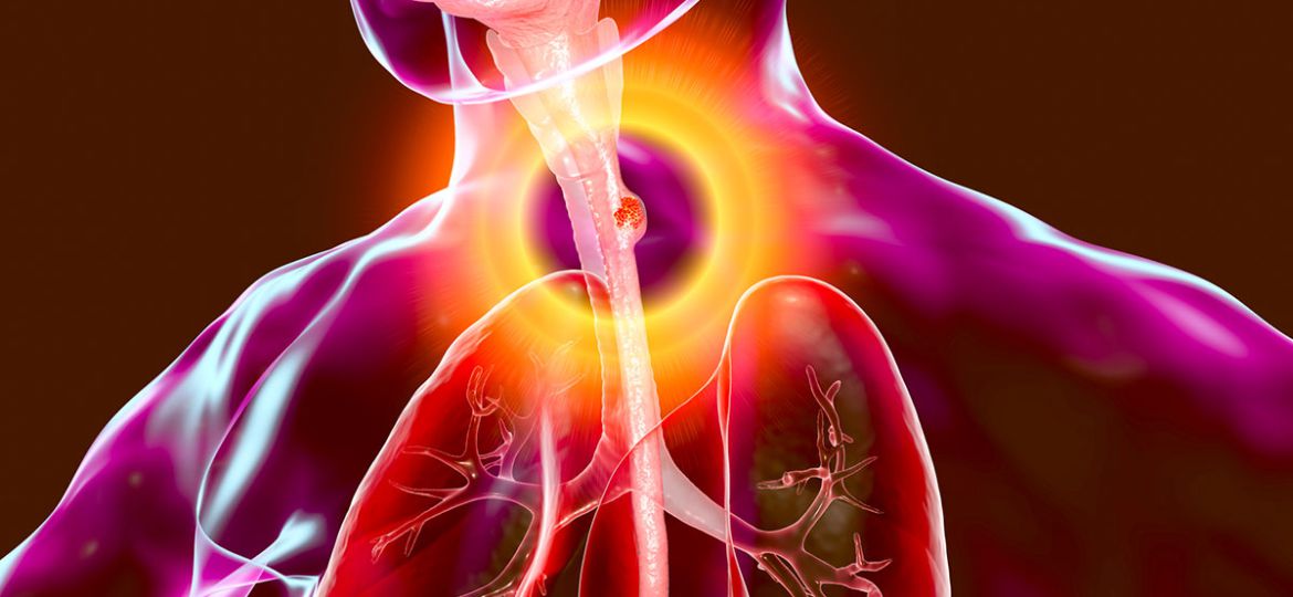 Esophageal Cancer head1