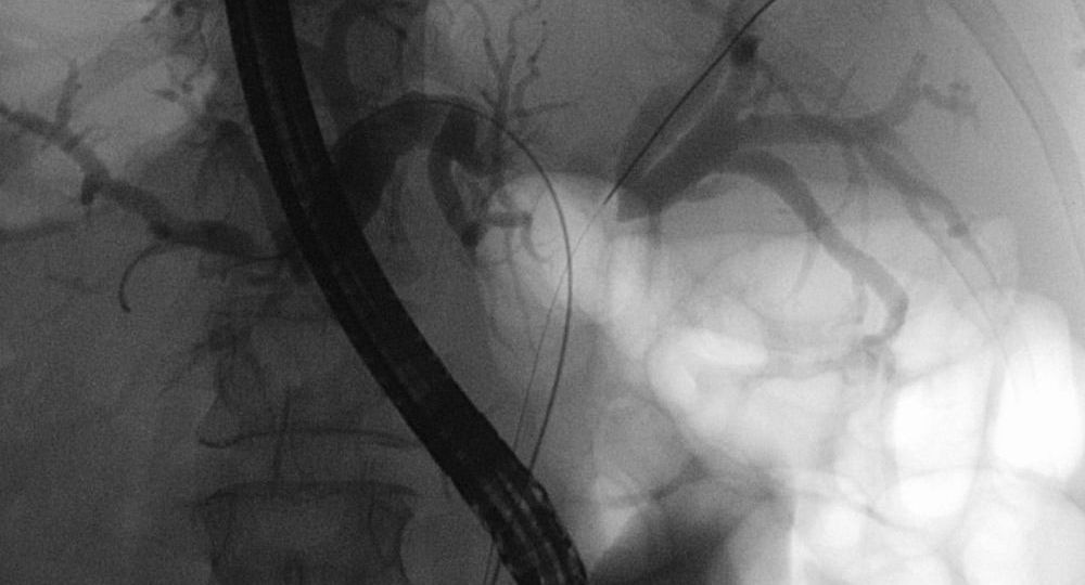 Klatskin Tumor head1