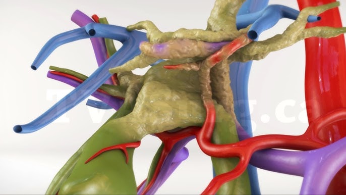 Klatskin Tumor head3