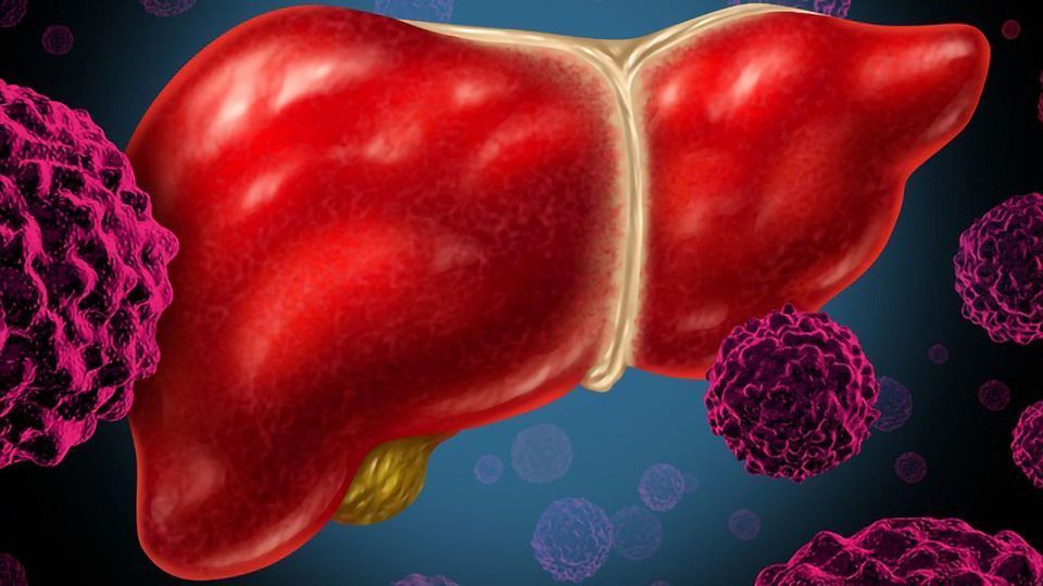 LIVER METASTASES head1