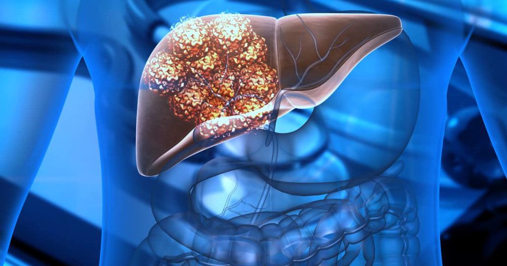 LIVER METASTASES head3