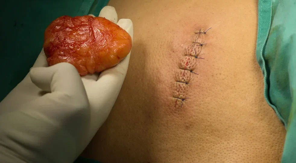 Lipoma head1