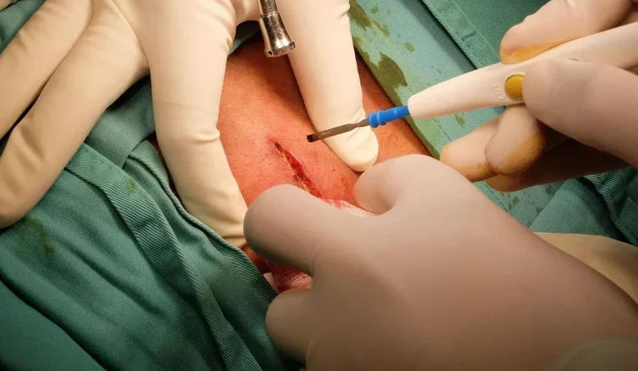 Lipoma head2