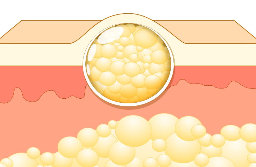 Lipoma head3