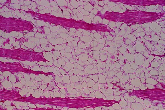 Lipoma head4