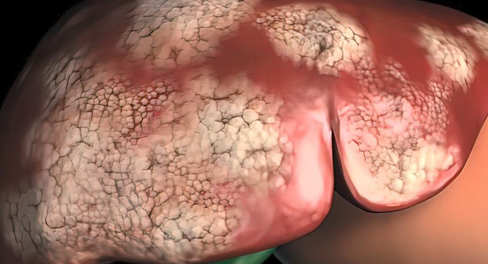 Liver Cancerr head1