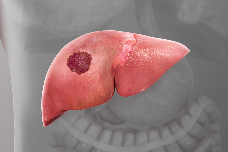 Liver Cancerr head2