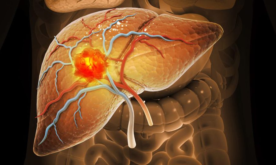 Liver cancer, Hepatocellular Carcinoma (HCC), conditions, causes and treatment. 3d illustration