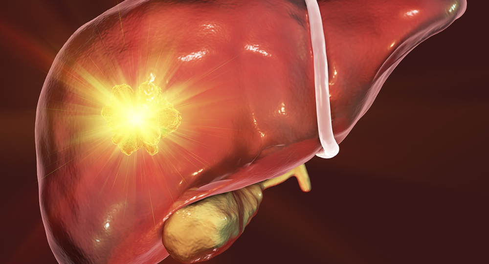 Liver Cancerr head4