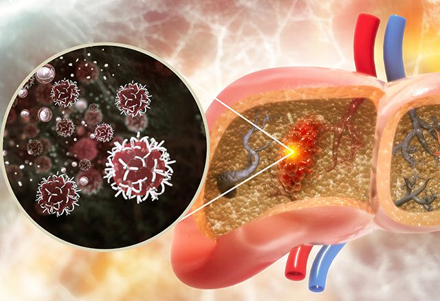 Liver Cancerr head6