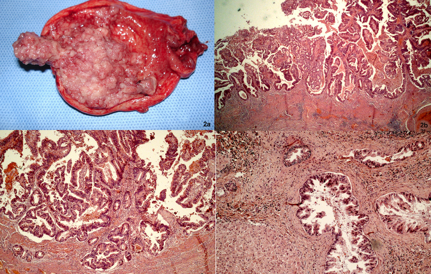 Papilla Vateri head1
