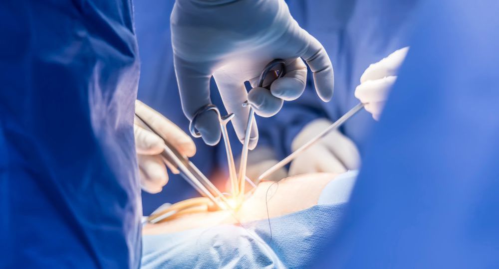 SPLEEN SURGERY H4