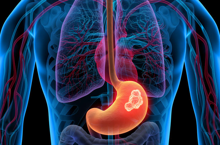 Body with stomach tumor