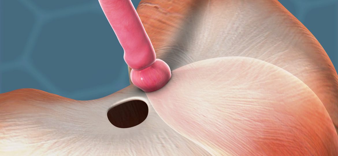 Stomach Hernia head1